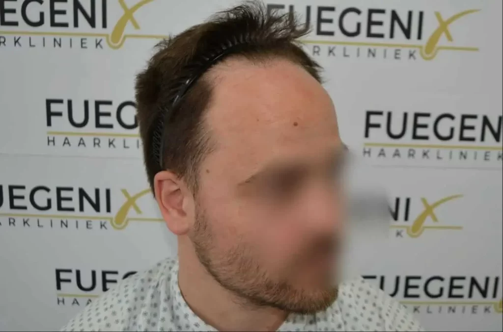 The Hairline That You Dream Of