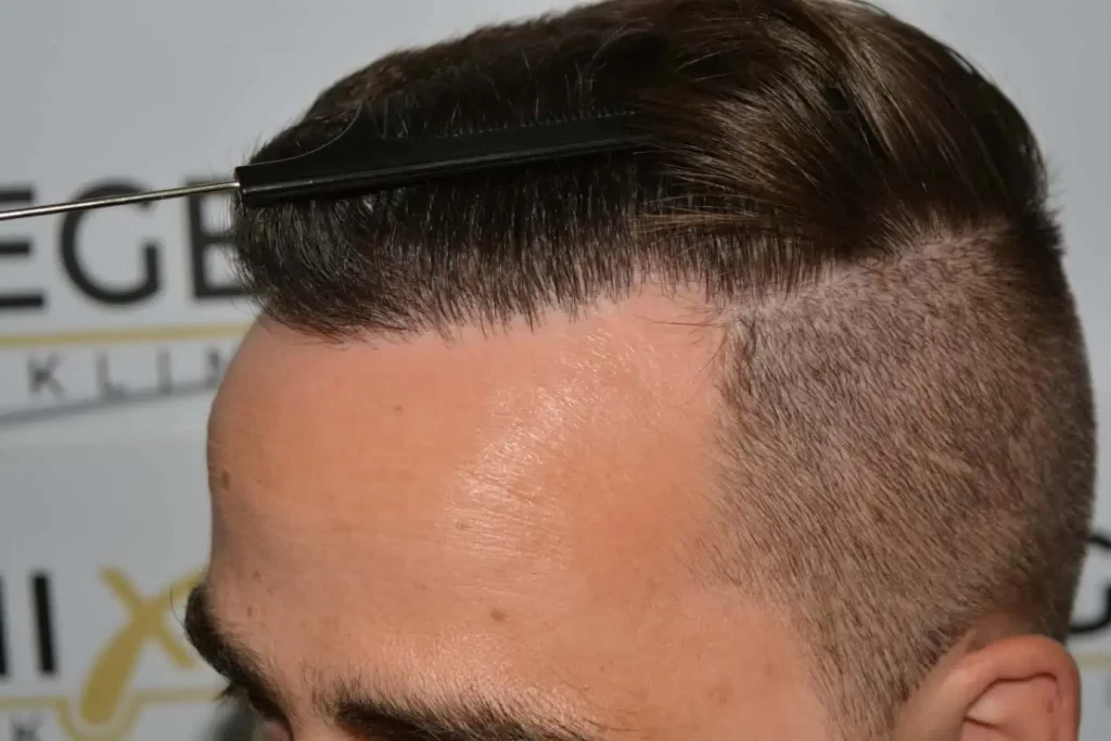 The Hairline That You Dream Of