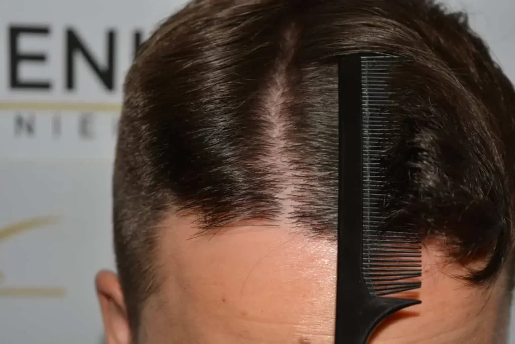The Hairline That You Dream Of