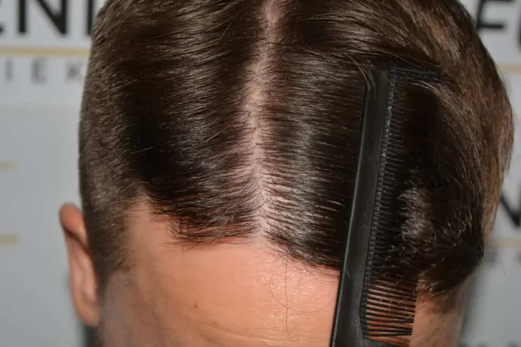 The Hairline That You Dream Of