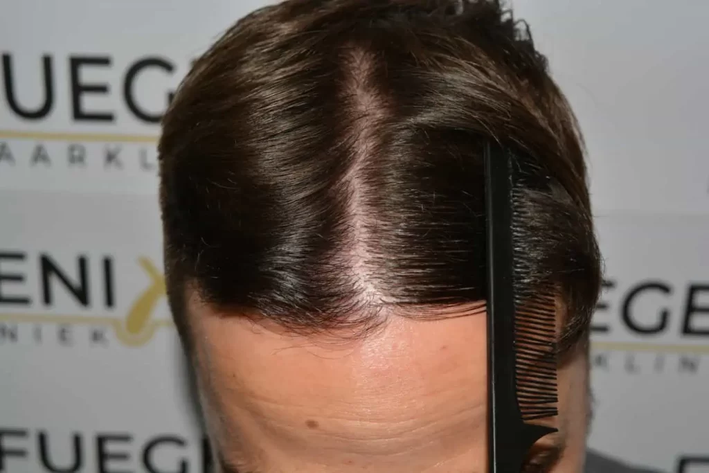 The Hairline That You Dream Of