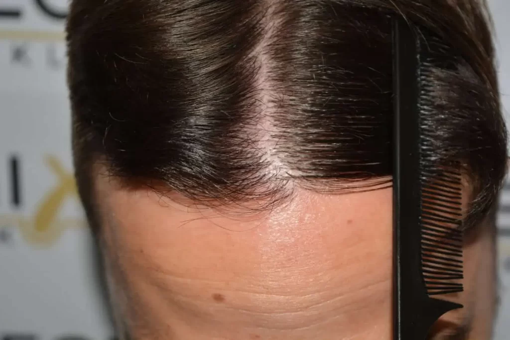 The Hairline That You Dream Of