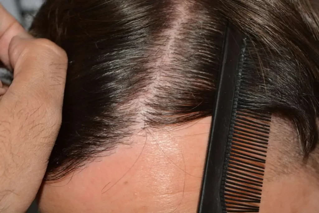 The Hairline That You Dream Of