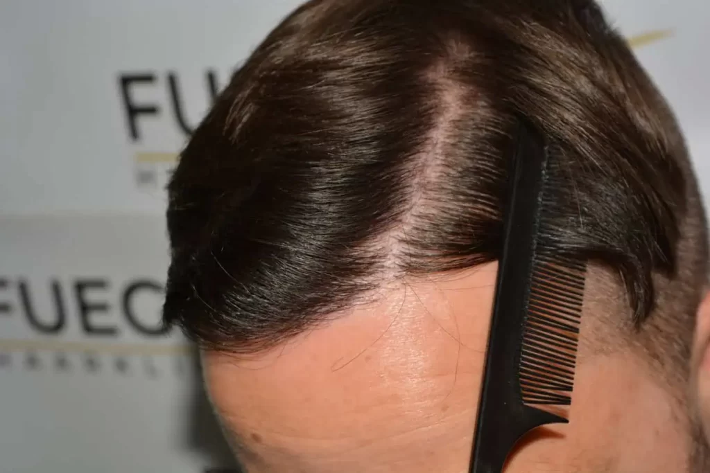 The Hairline That You Dream Of