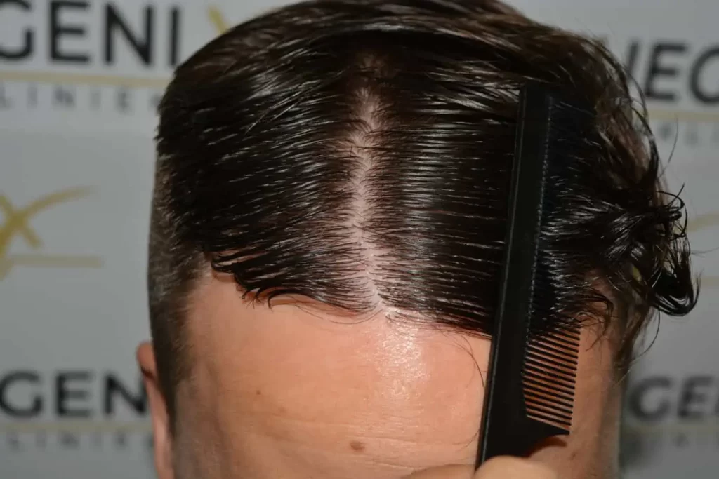 The Hairline That You Dream Of
