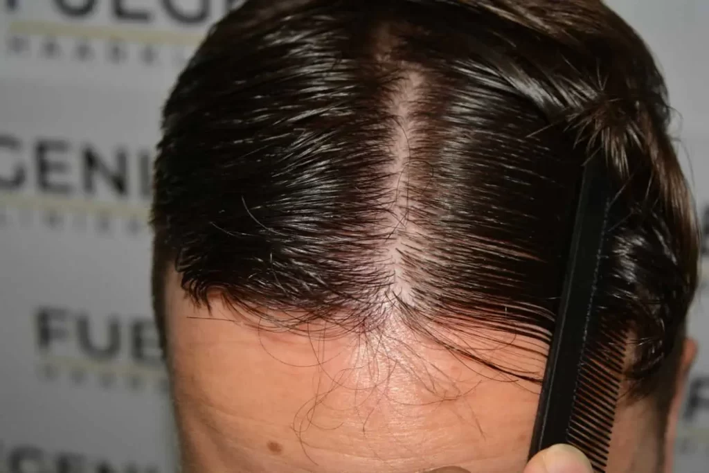 The Hairline That You Dream Of