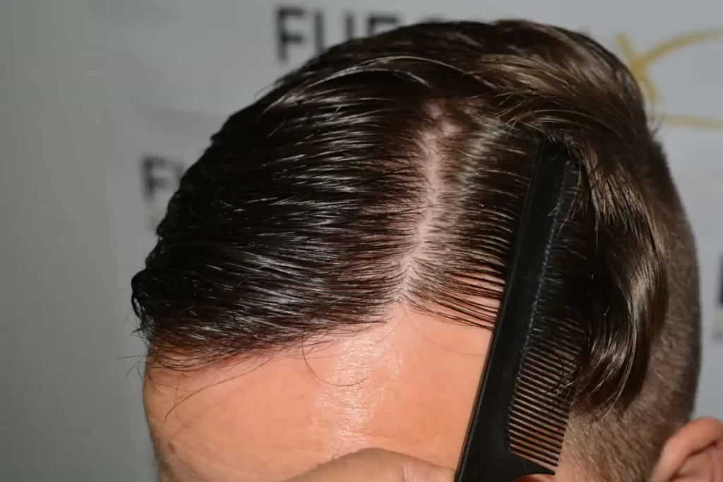 The Hairline That You Dream Of