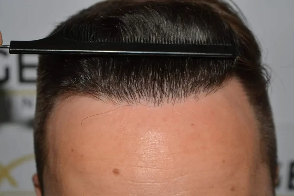 The Hairline That You Dream Of
