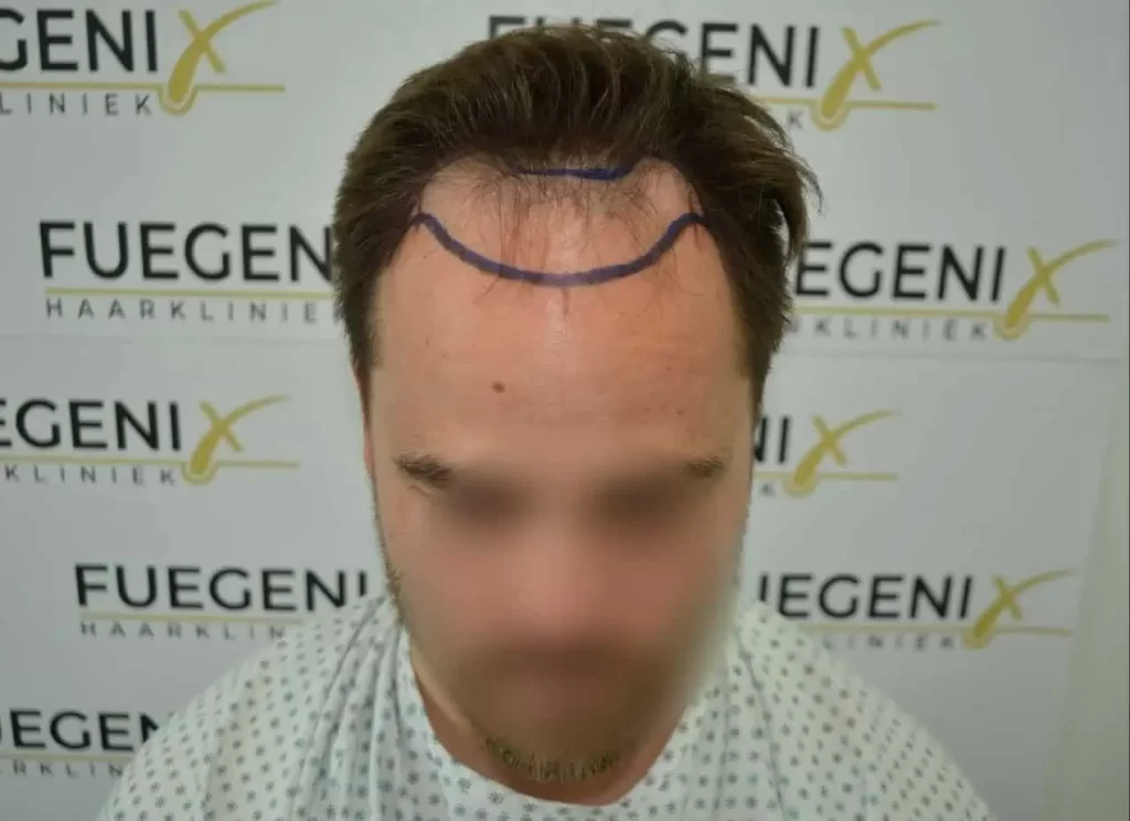 The Hairline That You Dream Of