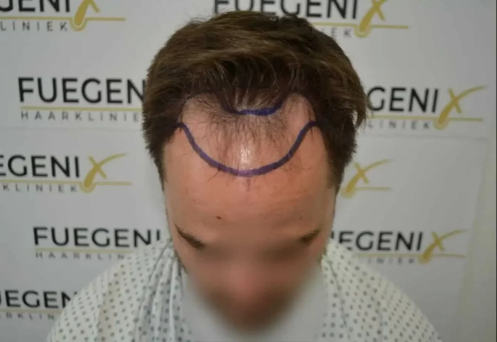 The Hairline That You Dream Of