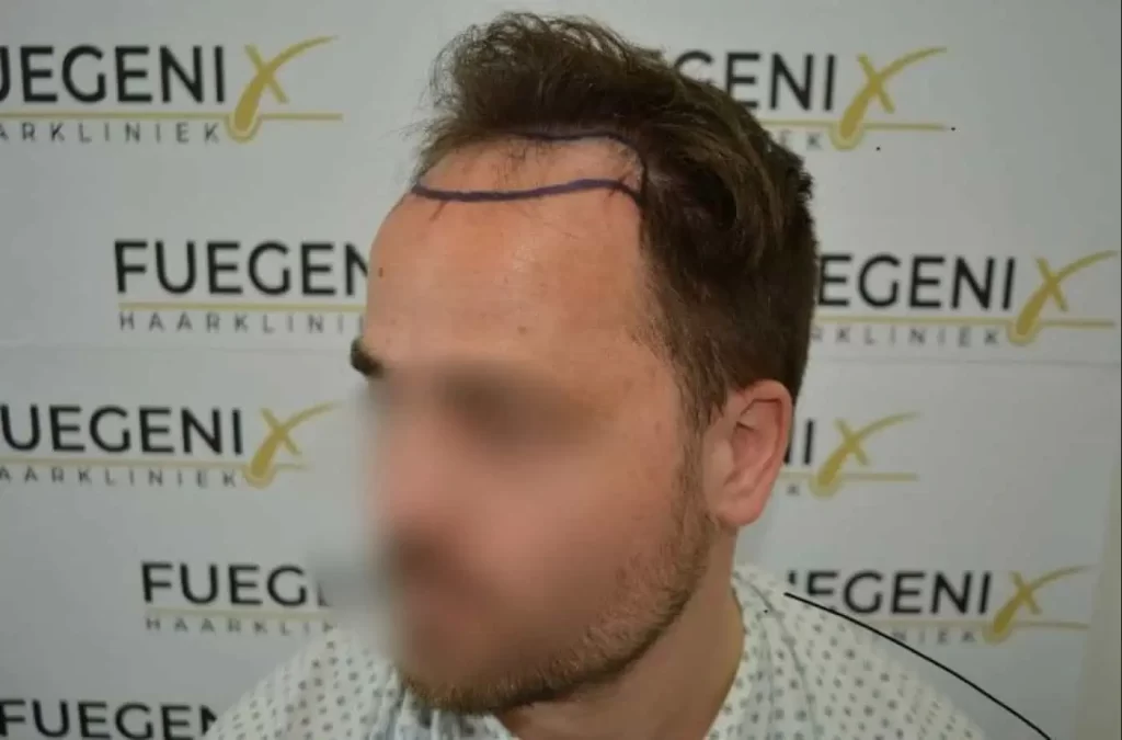 The Hairline That You Dream Of