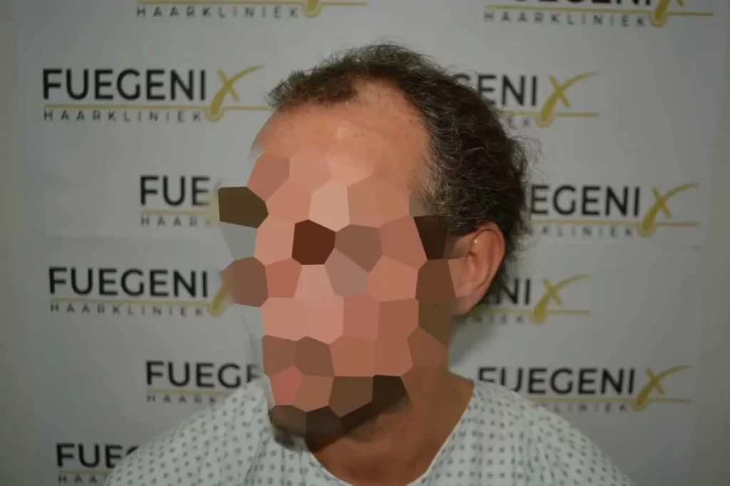 Curly Hairline