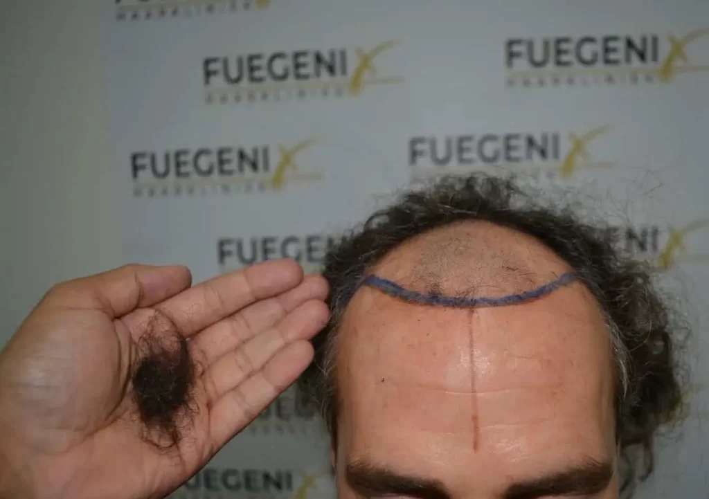 Curly Hairline