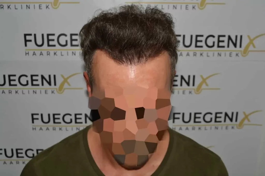 Curly Hairline