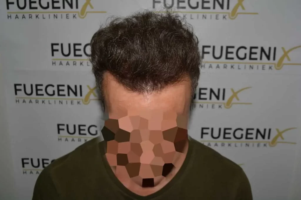 Curly Hairline