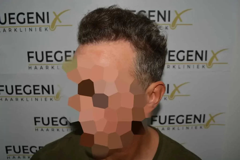 Curly Hairline