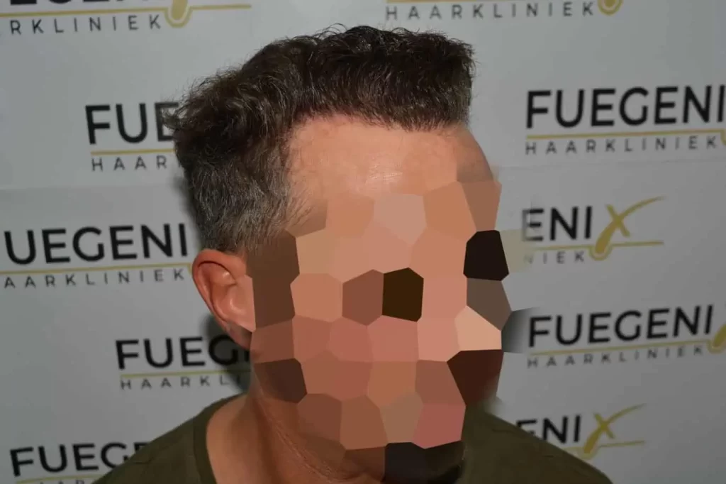 Curly Hairline