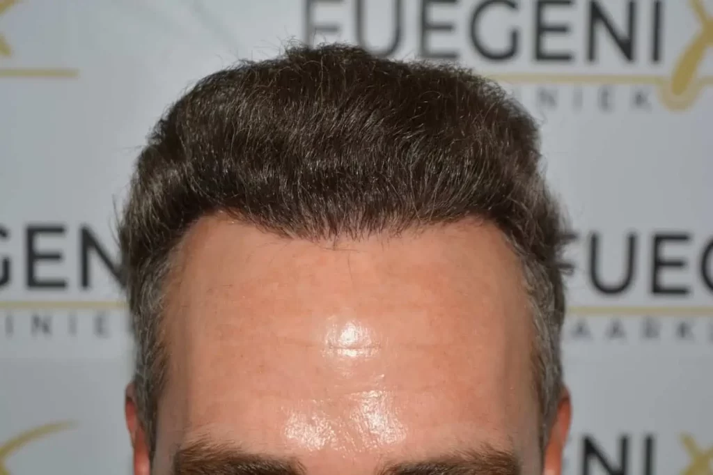 Curly Hairline