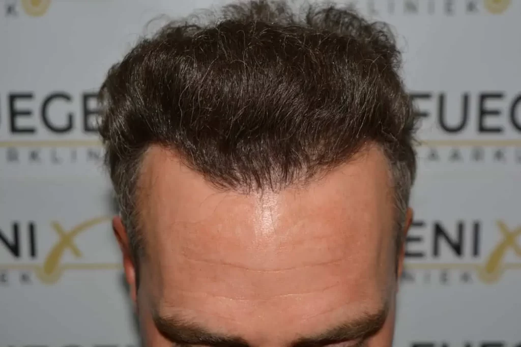 Curly Hairline