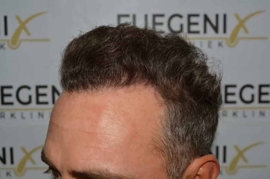 Curly Hairline
