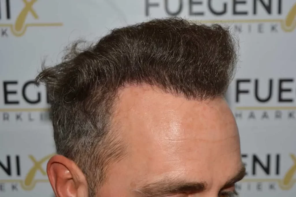 Curly Hairline