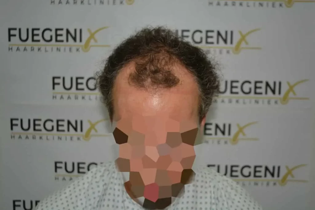 Curly Hairline