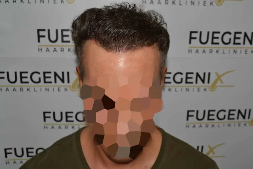 Curly Hairline