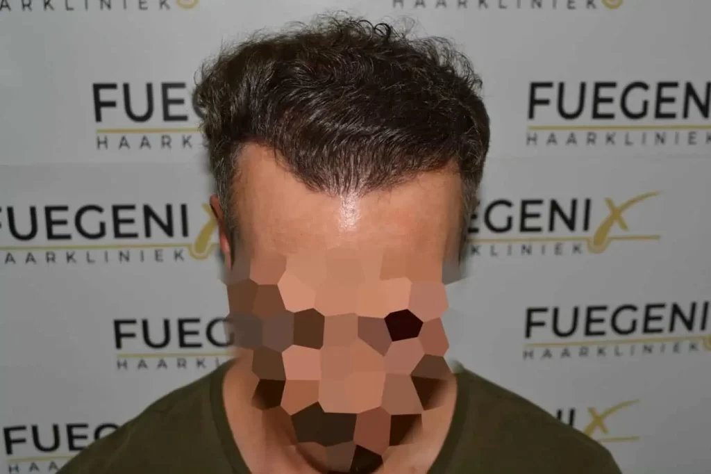 Curly Hairline