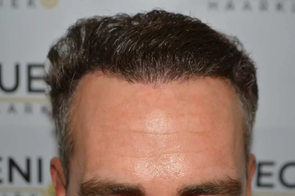 Curly Hairline