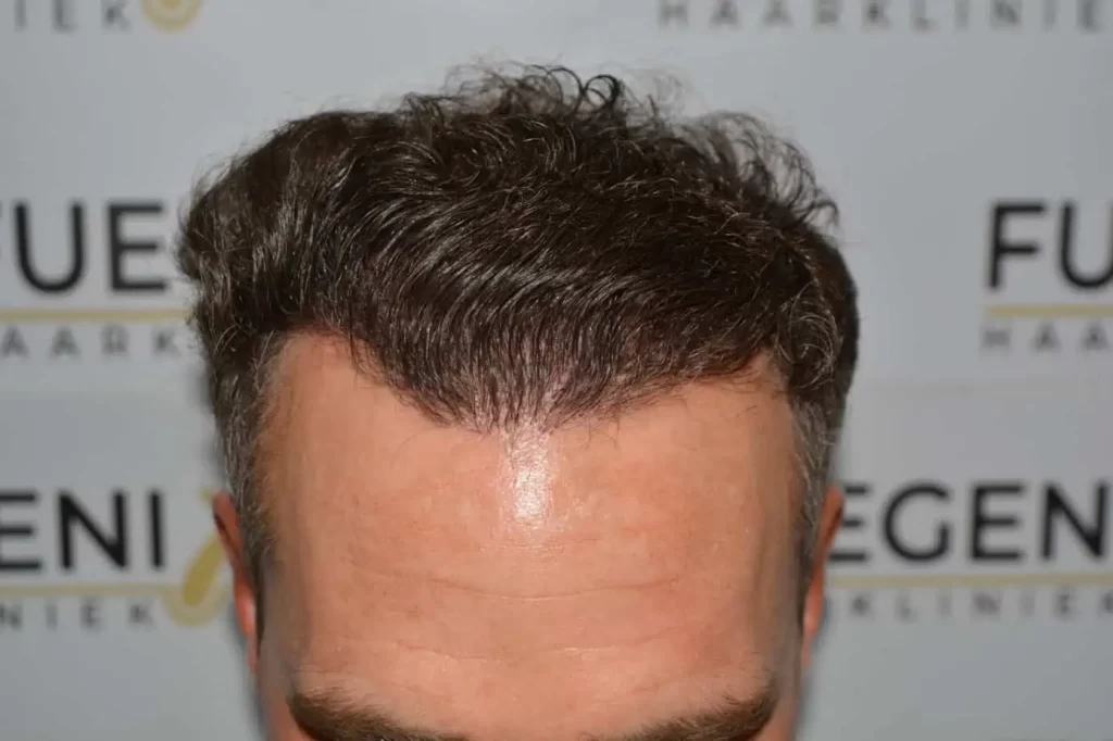Curly Hairline