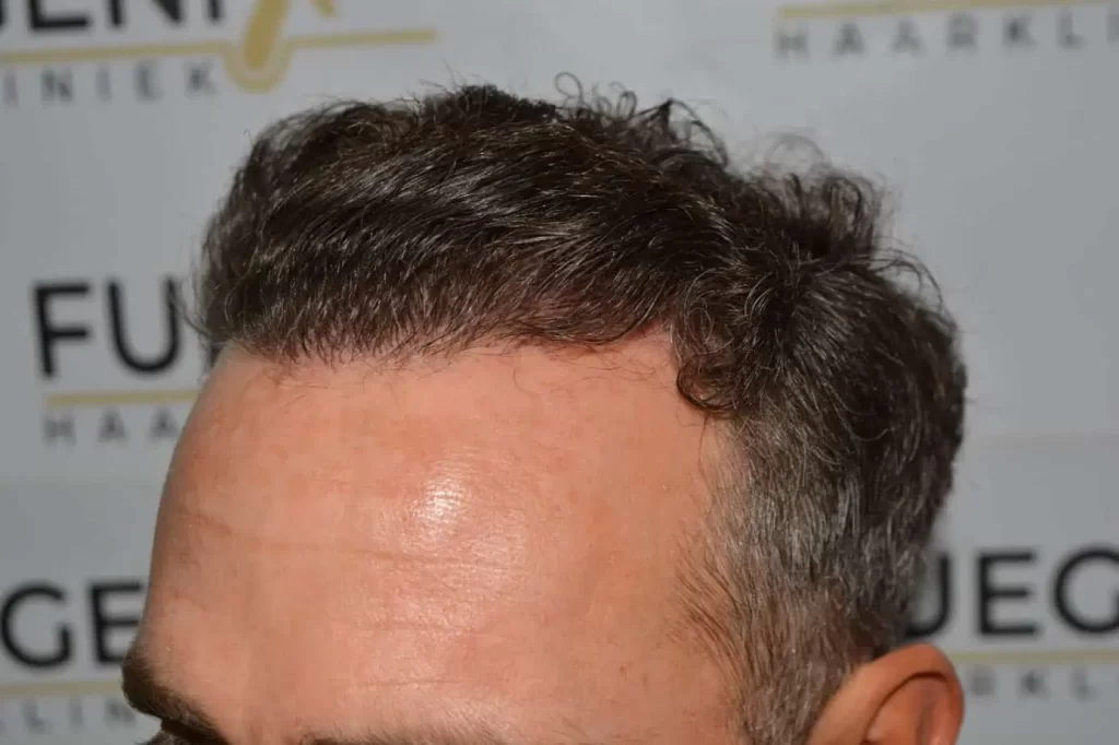 Curly Hairline