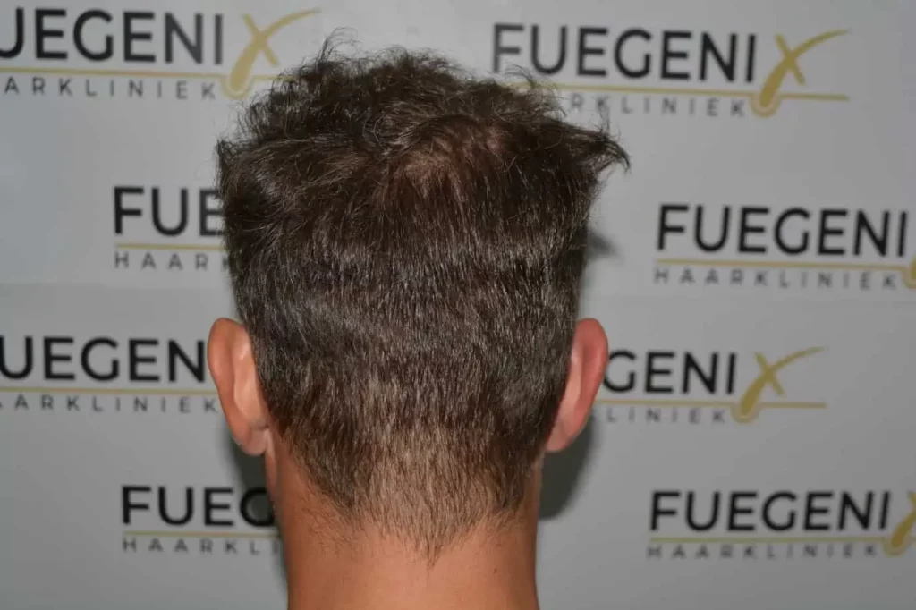 Curly Hairline