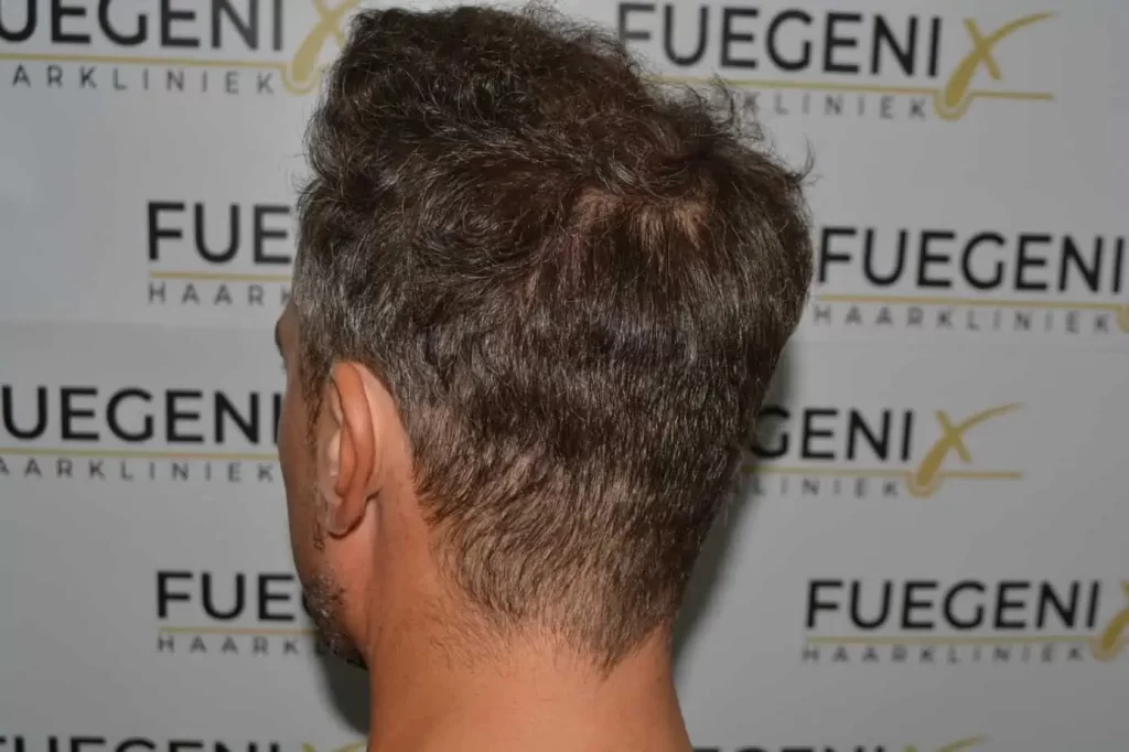 Curly Hairline