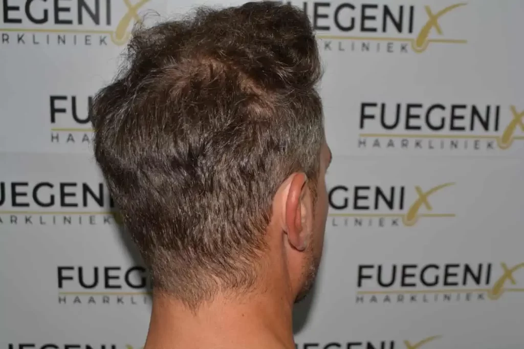 Curly Hairline
