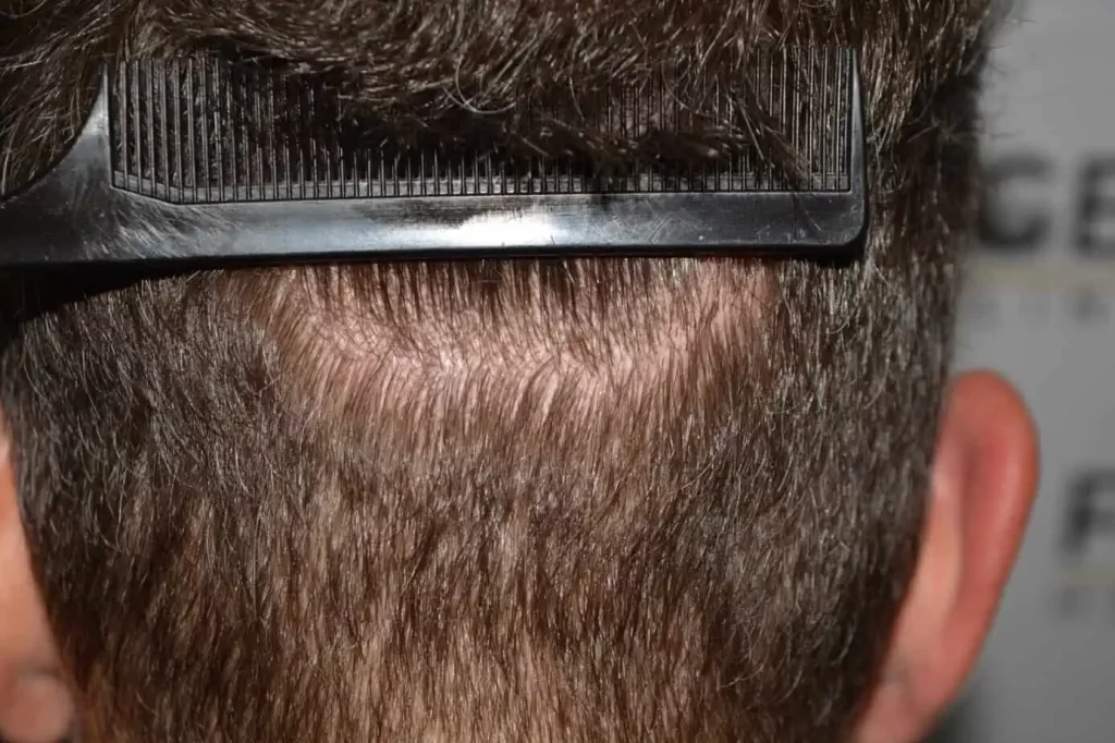 Curly Hairline