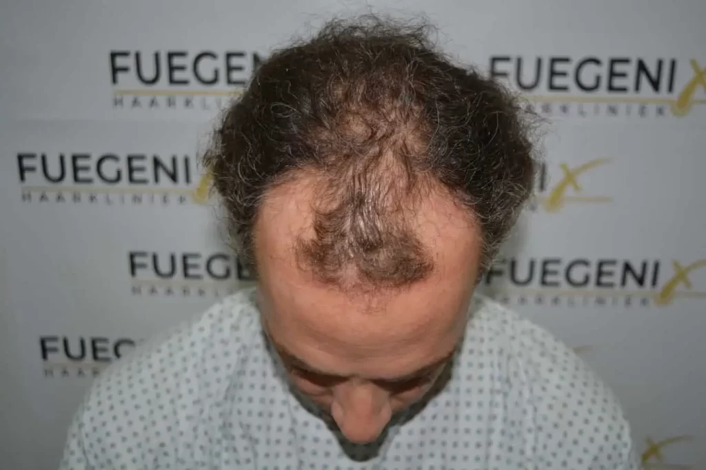 Curly Hairline