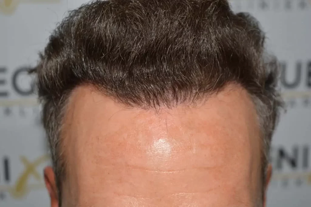Curly Hairline