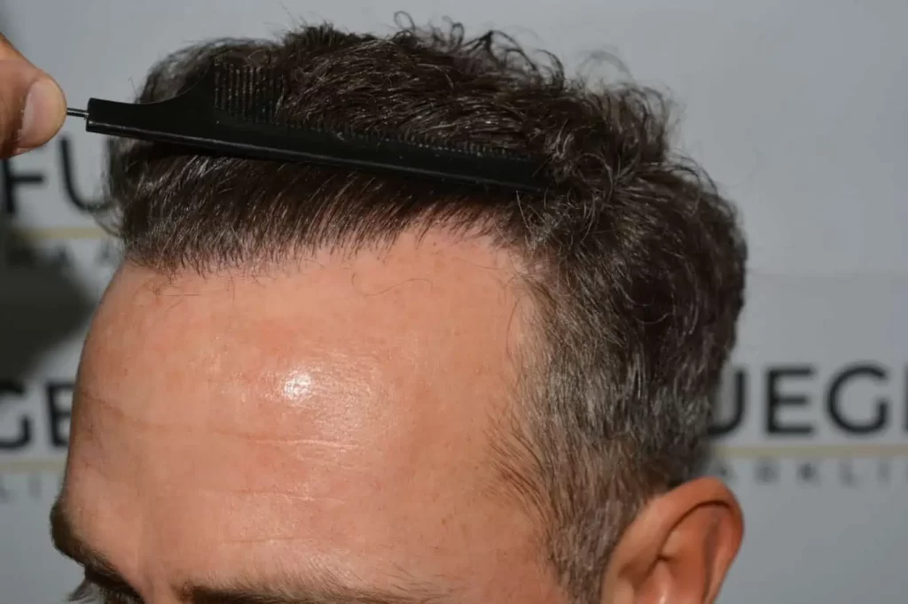 Curly Hairline