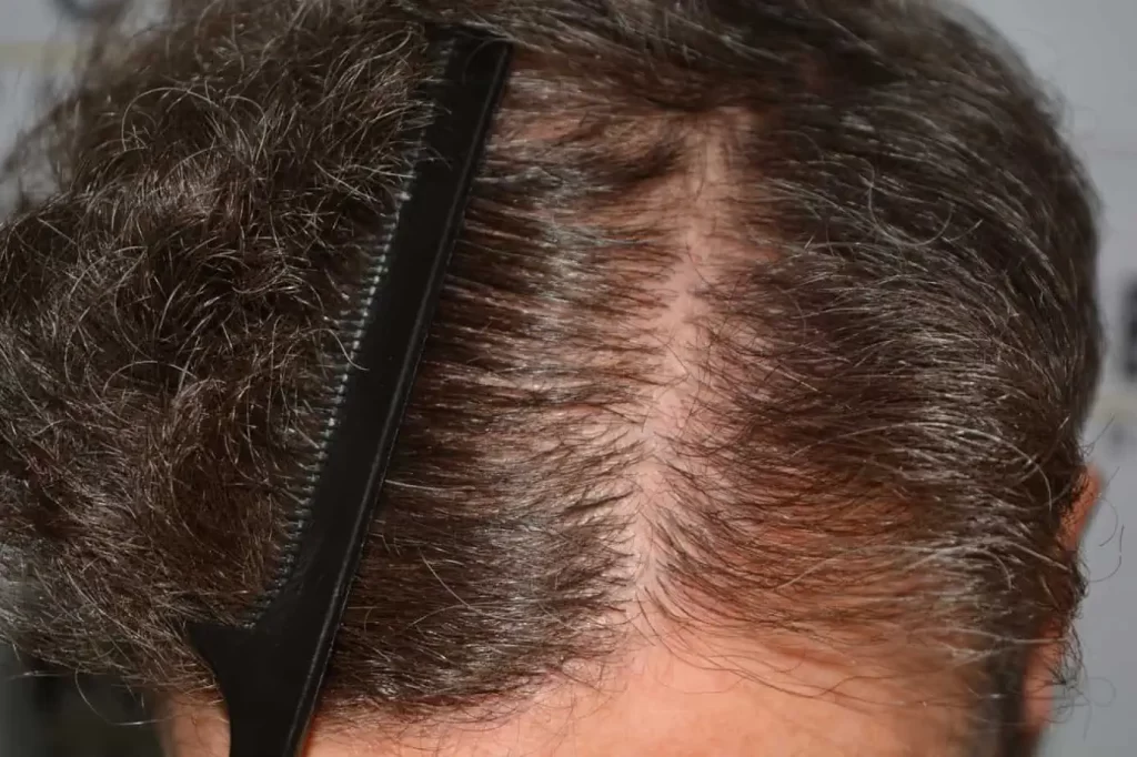 Curly Hairline