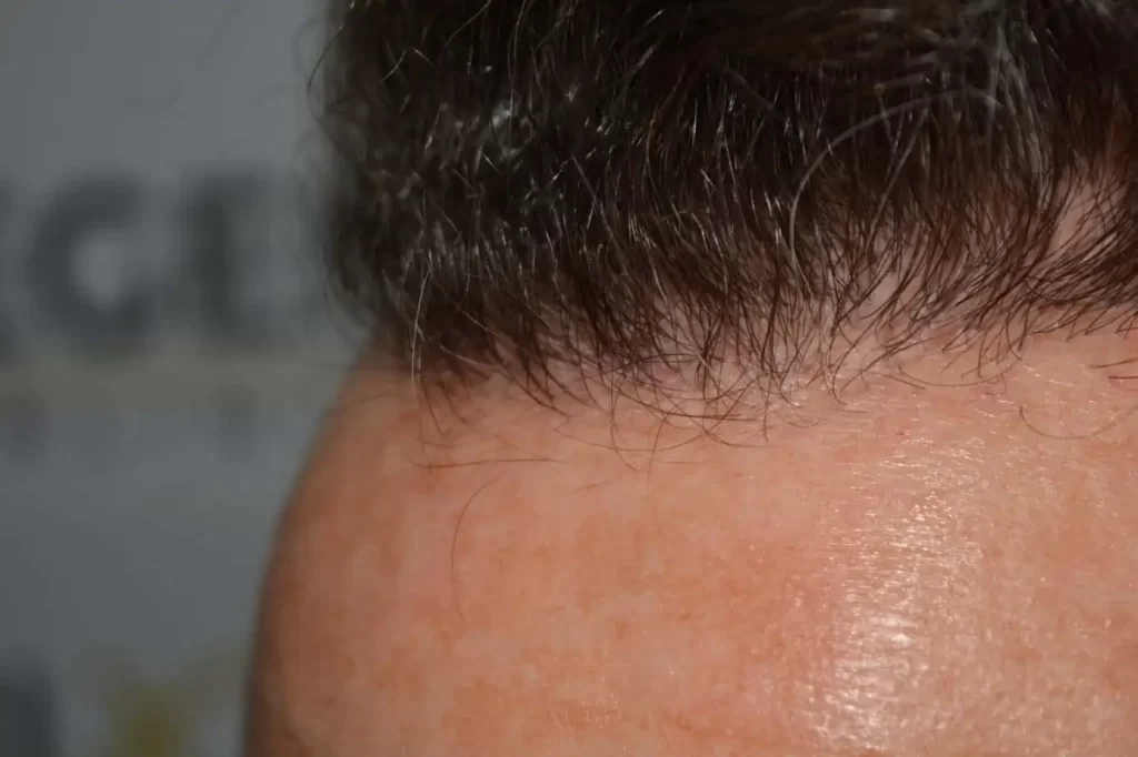 Curly Hairline