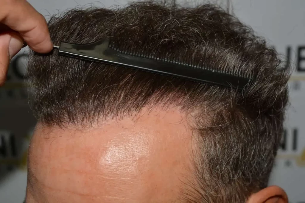 Curly Hairline