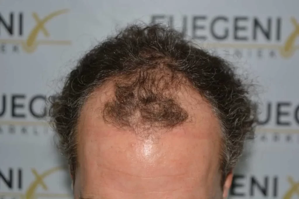 Curly Hairline