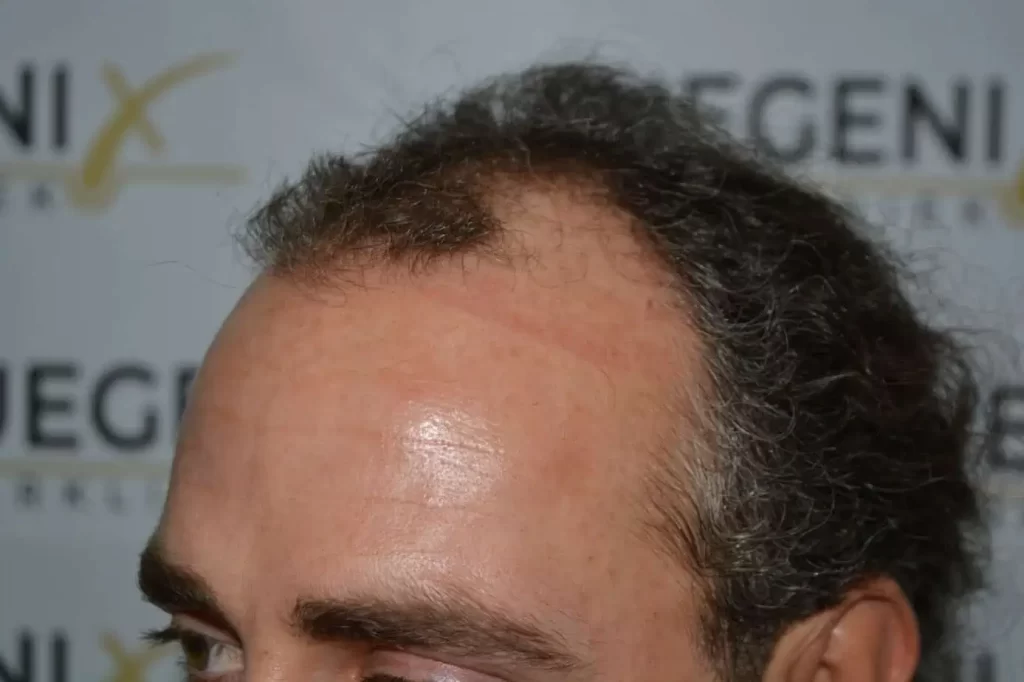 Curly Hairline