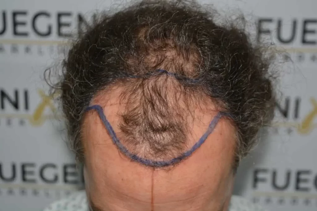 Curly Hairline