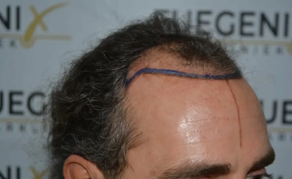 Curly Hairline