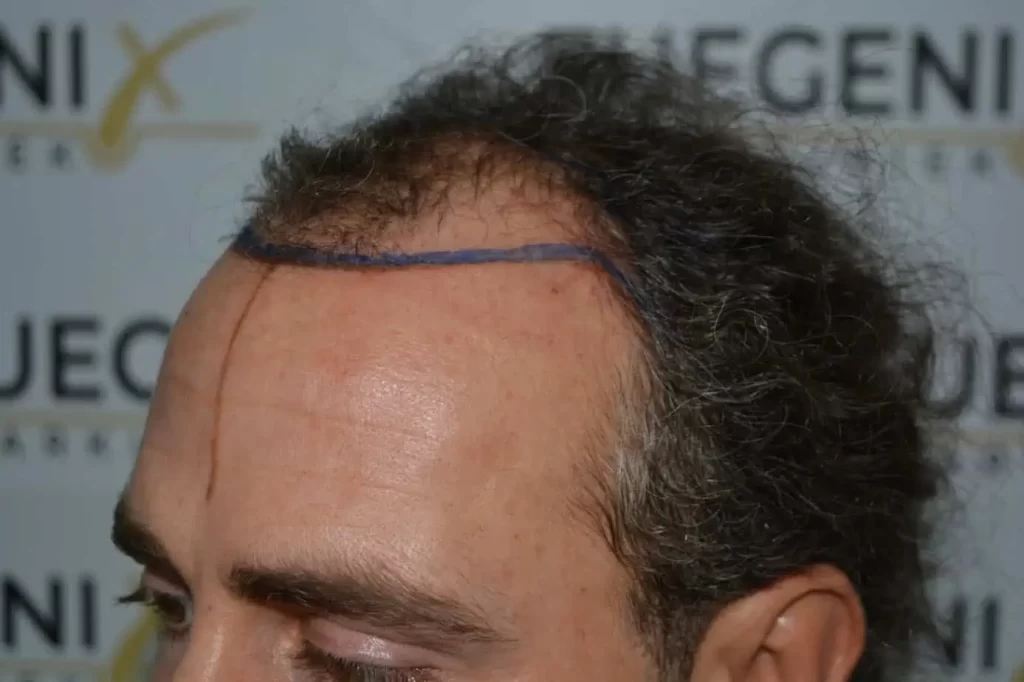 Curly Hairline