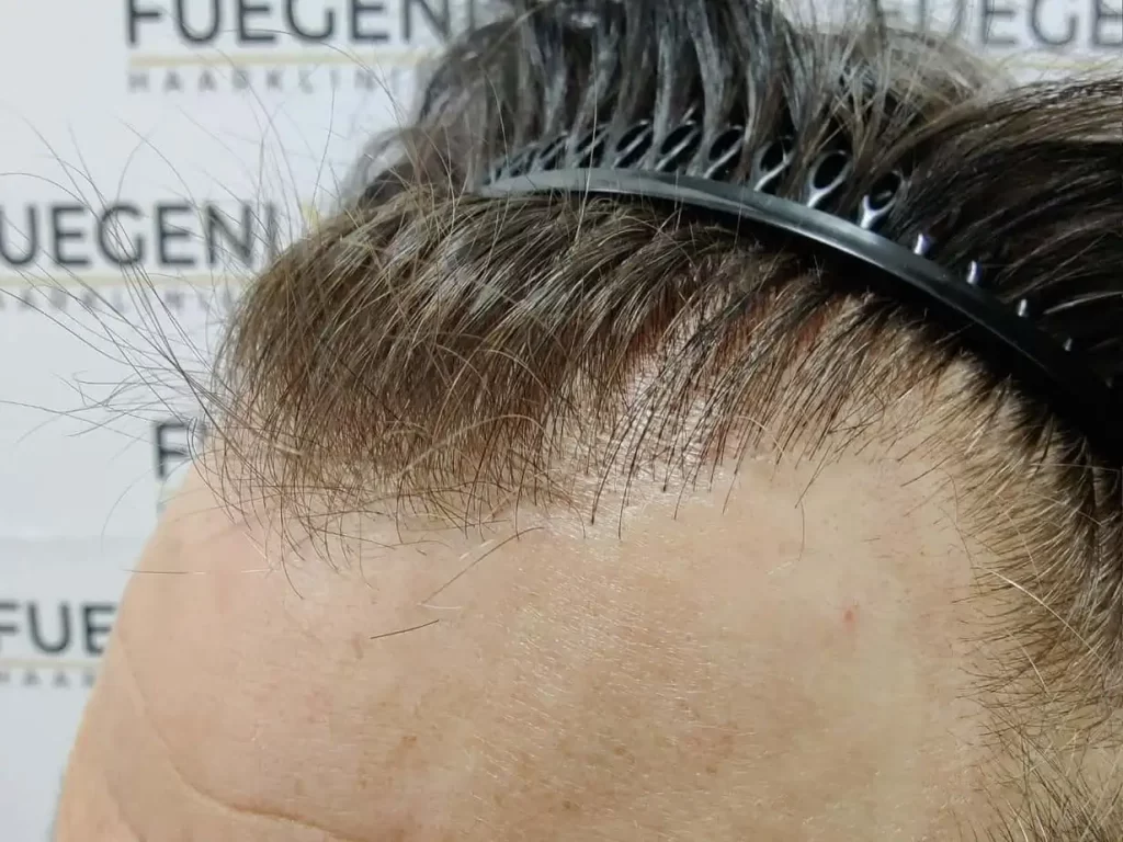 From Failed Hair Transplant To Shah Rukh Khan