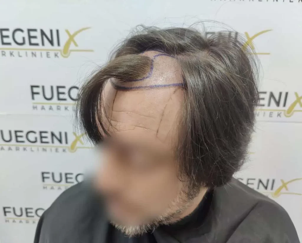 From Failed Hair Transplant To Shah Rukh Khan