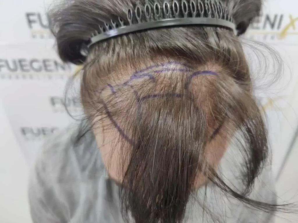 From Failed Hair Transplant To Shah Rukh Khan