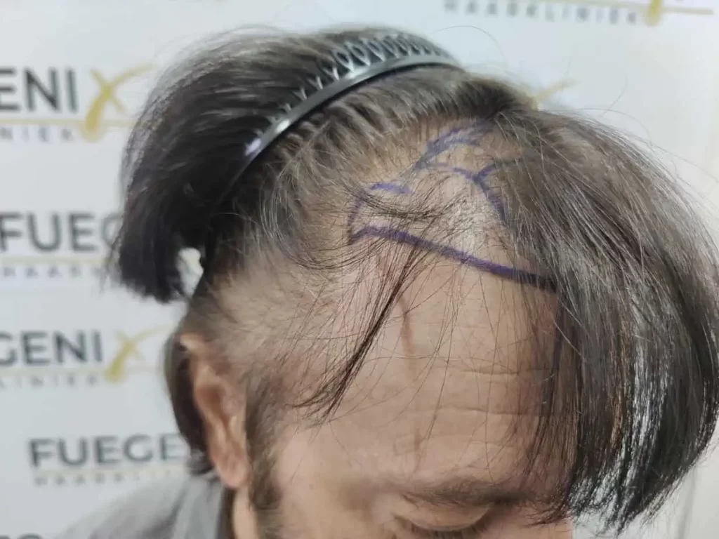 From Failed Hair Transplant To Shah Rukh Khan